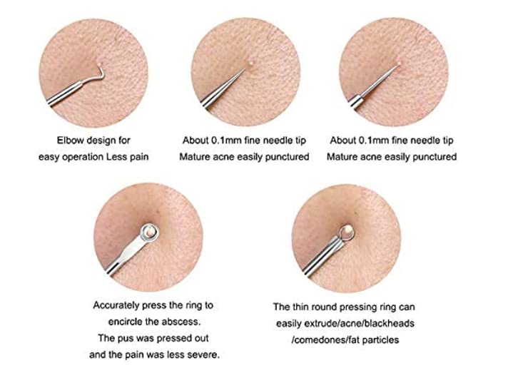 Professional Blackhead Remover Tool - Dual Head Stainless Steel Extractor for Pimples, Milia & Pus Removal (Round & Pointed Tips, Pack of 2) - Perfect for Facial Care & Acne Treatment at Home