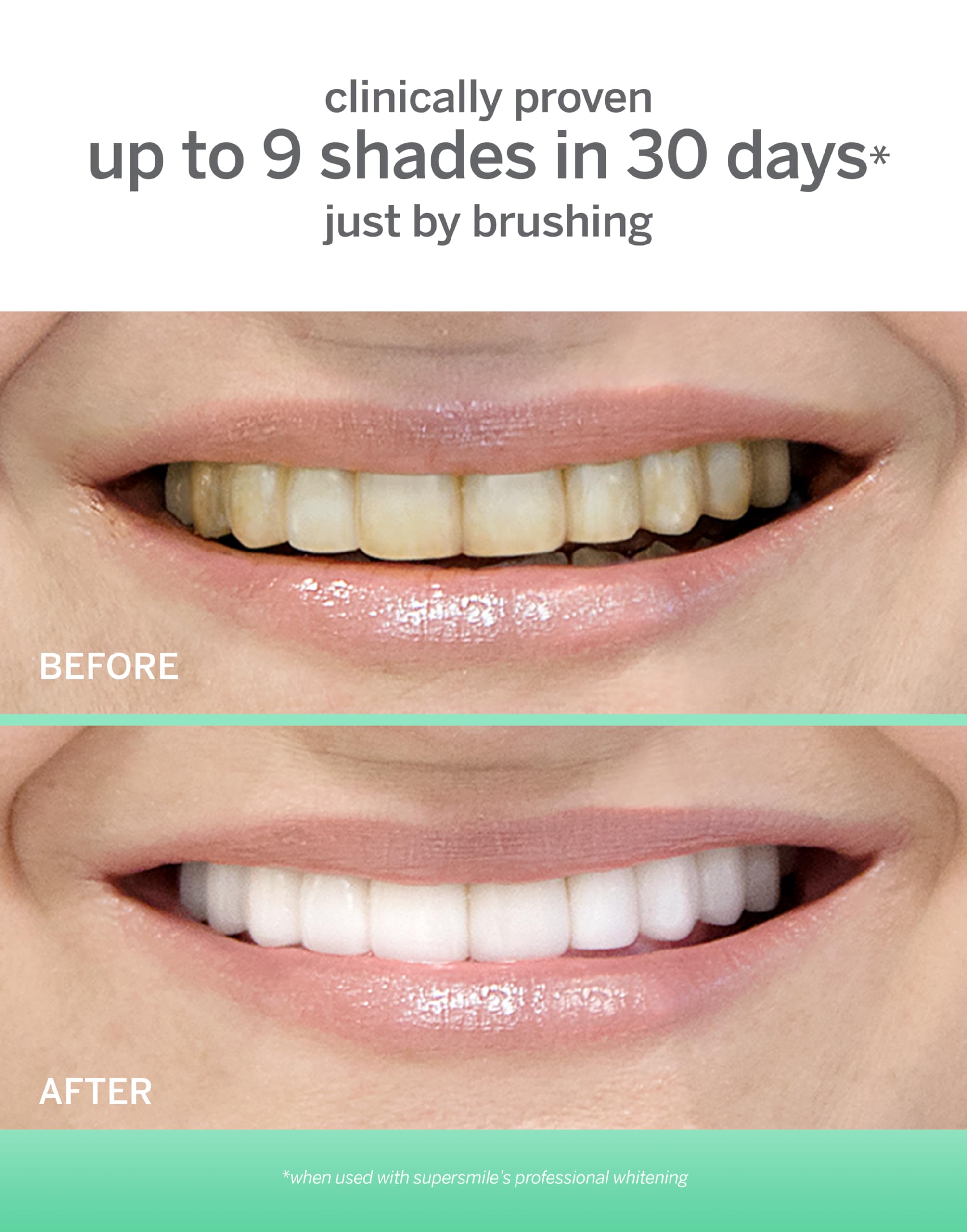 Supersmile Extra White Teeth Whitening System - Professional Dental Grade Whitening Kit for Brighter, Whiter Smile at Home | Perfect for Daily Use, Travel & Special Occasions