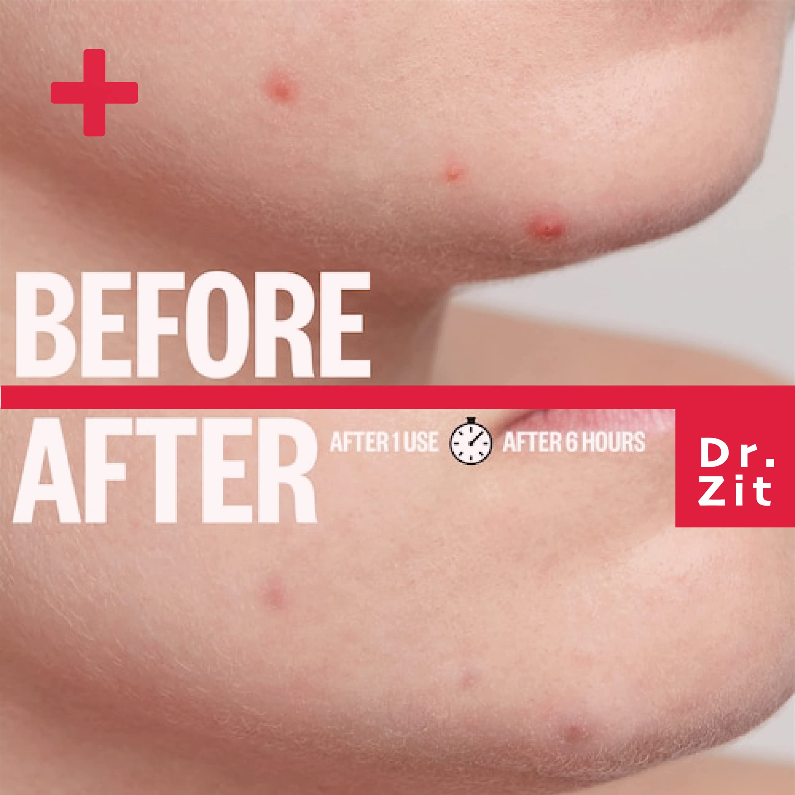 Dr. Zit Spot Patch - Hydrocolloid Acne Pimple Patches (42 Dots, 3 Sizes) for Blemish Treatment | Korean Made Sterilized | Perfect for Overnight Acne Care & On-the-Go Skin Rescue