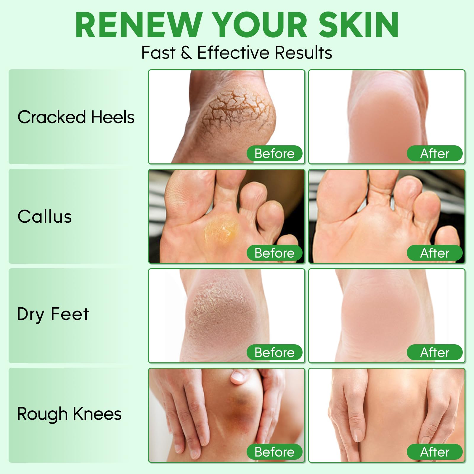 Tea Tree Oil Foot Soak & 40% Urea Cream with Callus Remover - Moisturizing Pedicure Set for Dry Cracked Heels & Tired Feet - Foot Care Kit for Women & Men | Perfect for Home Spa, Relaxation & Cracked Heel Treatment