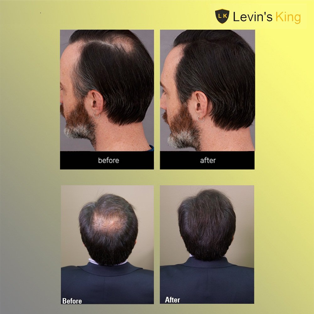 Levins King Hair Building Fiber - Dark Brown Hair Concealer Refill Pack for Thinning Hair | Works with Caboki & Other Hair Fibers | Instant Coverage for Bald Spots & Receding Hairlines