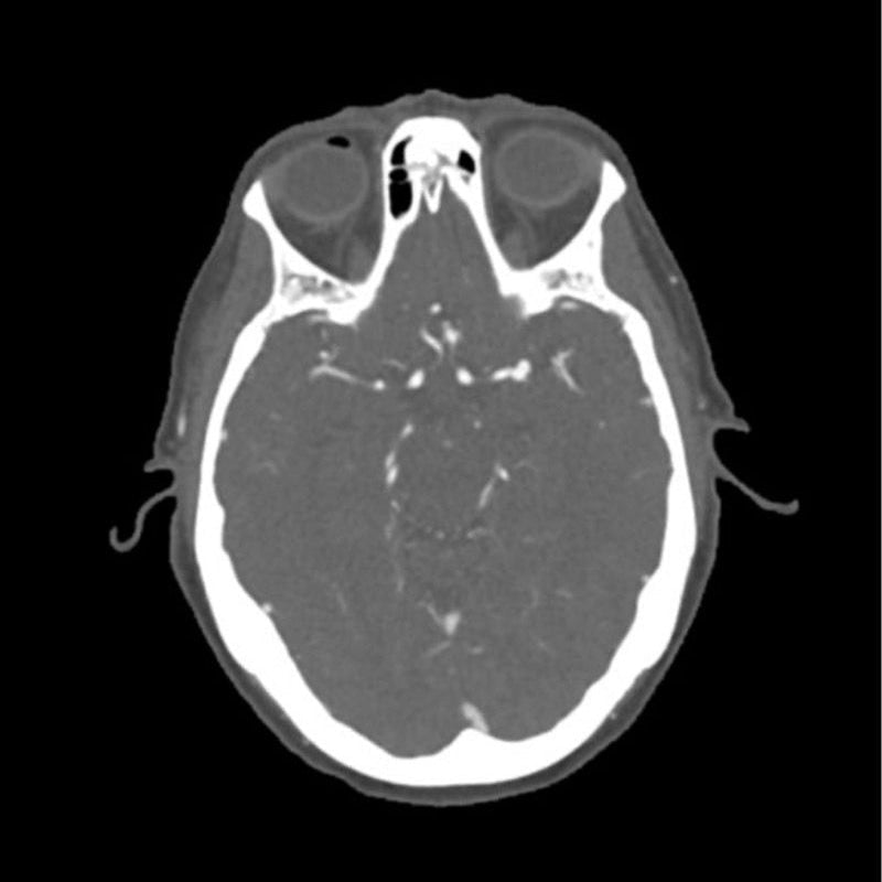 CTA Aneurysm Head Phantom for CT Scan and X-Ray Training - High-Quality Medical Simulation Tool for Radiology Education and Diagnostic Practice
