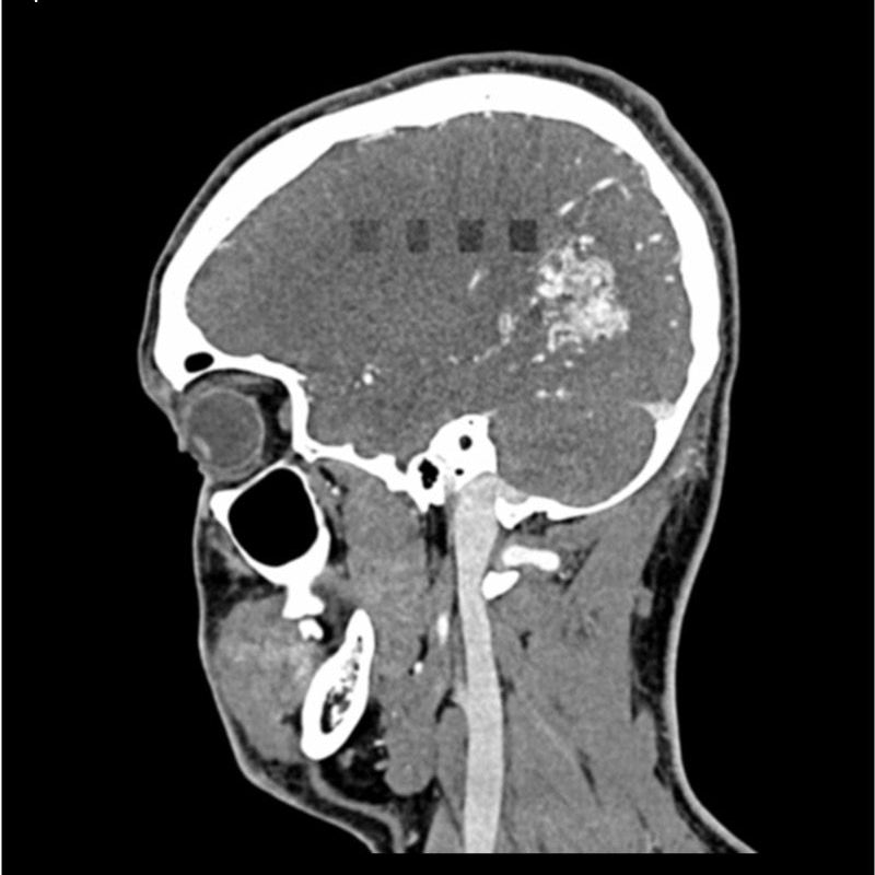 CTA AVM / Lesion Head and Neck Phantom for CT Scan & X-Ray Training - Medical Imaging Practice, Radiology Education, and Diagnostic Procedure Simulation