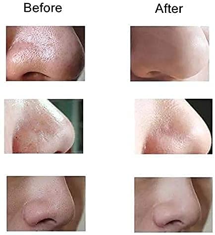 Shraddha Saburi Electric Acne Pore Cleaner - Blackhead Remover Vacuum with ABS Material - Professional Derma Suction Machine for Clear Skin | Perfect for Home Spa & Facial Care Routine