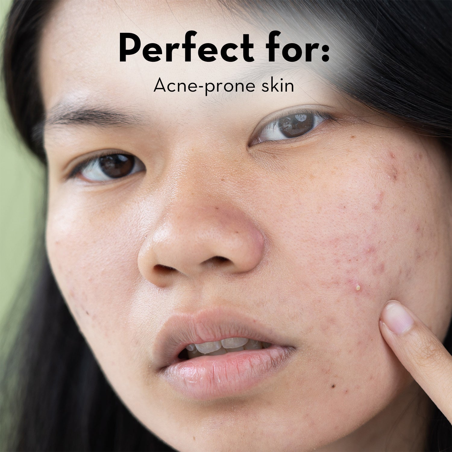 Zitlox Salicylic Acid Acne Treatment Gel - Fast-Acting Spot Treatment for Face & Body - Best for Teen & Adult Acne, Pimples & Breakouts - Use for Oily Skin, Blackheads & Blemishes