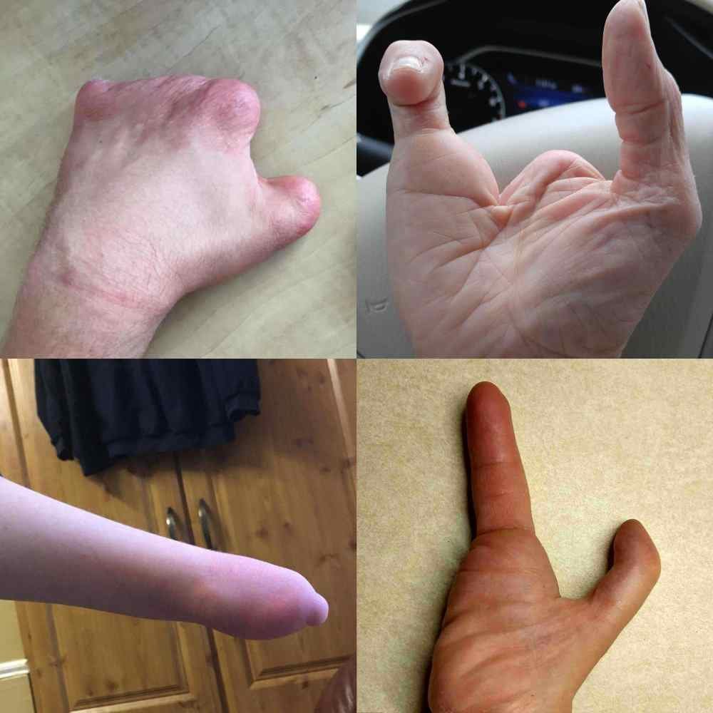 Active Hands Limb Difference Aid - Adaptive Grip Assist for Gym & Home Use - Ideal for Amputees, Missing Fingers or Hand Parts - Perfect for Weightlifting, Yoga & Daily Activities