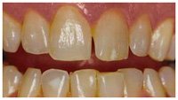 INSTANT WHITE SMILES 36% Teeth Whitening Gel - Professional Deep Stain Removal with 2x10ml Syringes & 2 Remineralizing Trays | At-Home Whitening Kit for Coffee, Wine & Smoking Stains