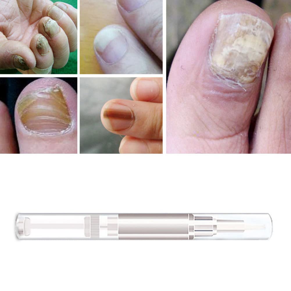 Allbestaye Fungal Nail Repair Pen - Effective Treatment for Onychomycosis & Paronychia, Restores Healthy Nails Damaged by Fungus | Anti-Fungal Nail Infection Solution for Toenails & Fingernails | Perfect for Daily Nail Care & Salon Use