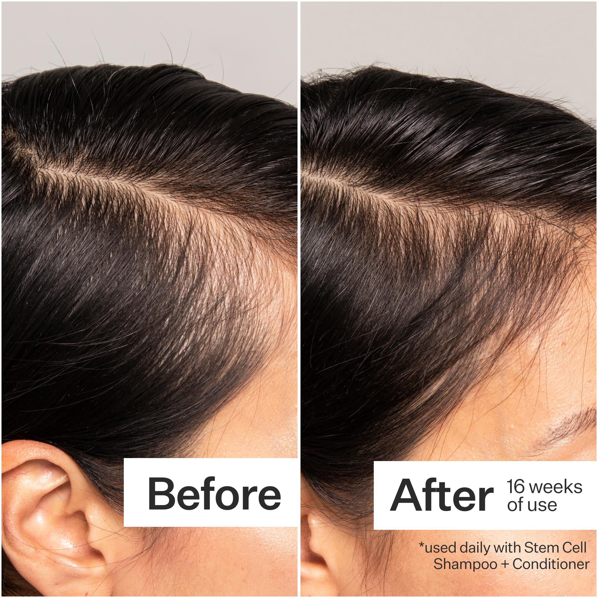 Act+Acre 3% Stem Cell Peptide Hair Treatment for Thinning Hair - Stimulates Hair Growth & Reduces Breakage - Perfect for Daily Scalp Care & Hair Regrowth Routine