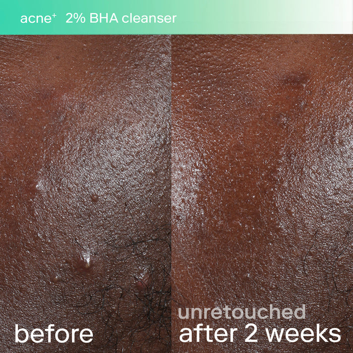 Acne+ Triple Threat Set - Acne Treatment Kit for Clear Skin | Best for Teen & Adult Acne Care | Use for Daily Skincare Routine & Breakout Control