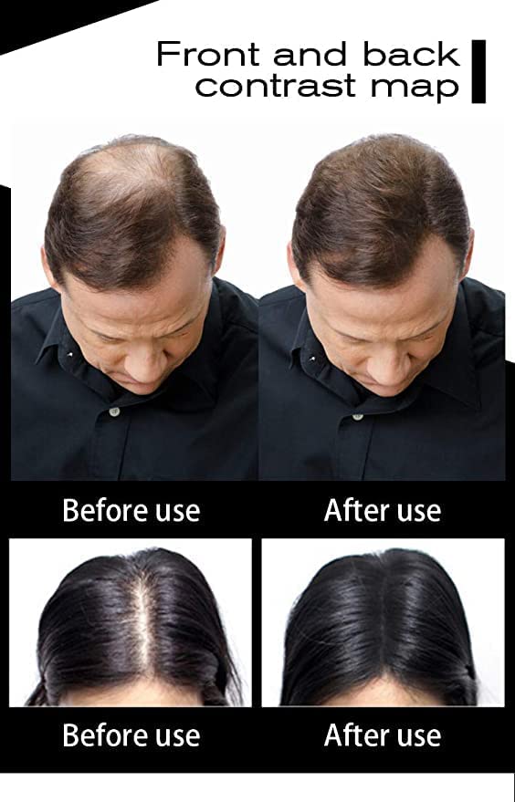 Sevich All Hair Building Fiber Refill - 25g Black Hair Thickening Powder for Men & Women - Instant Hair Loss Concealer for Thinning Hair - Perfect for Daily Use, Special Occasions & Confidence Boosting