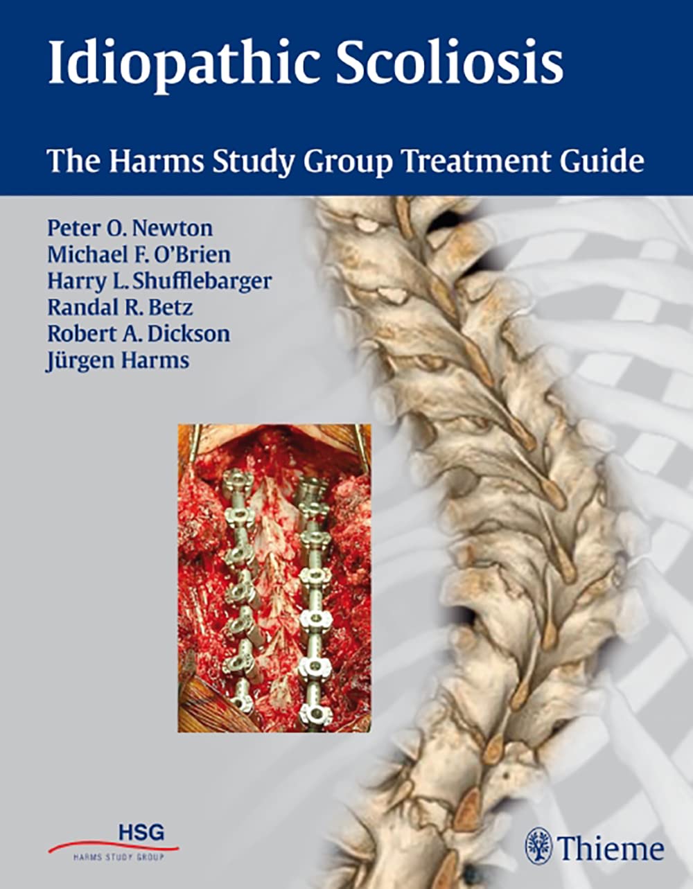 Idiopathic Scoliosis Treatment Guide - Harms Study Group Recommendations for Spinal Correction & Pain Relief | For Doctors, Physical Therapists & Patients