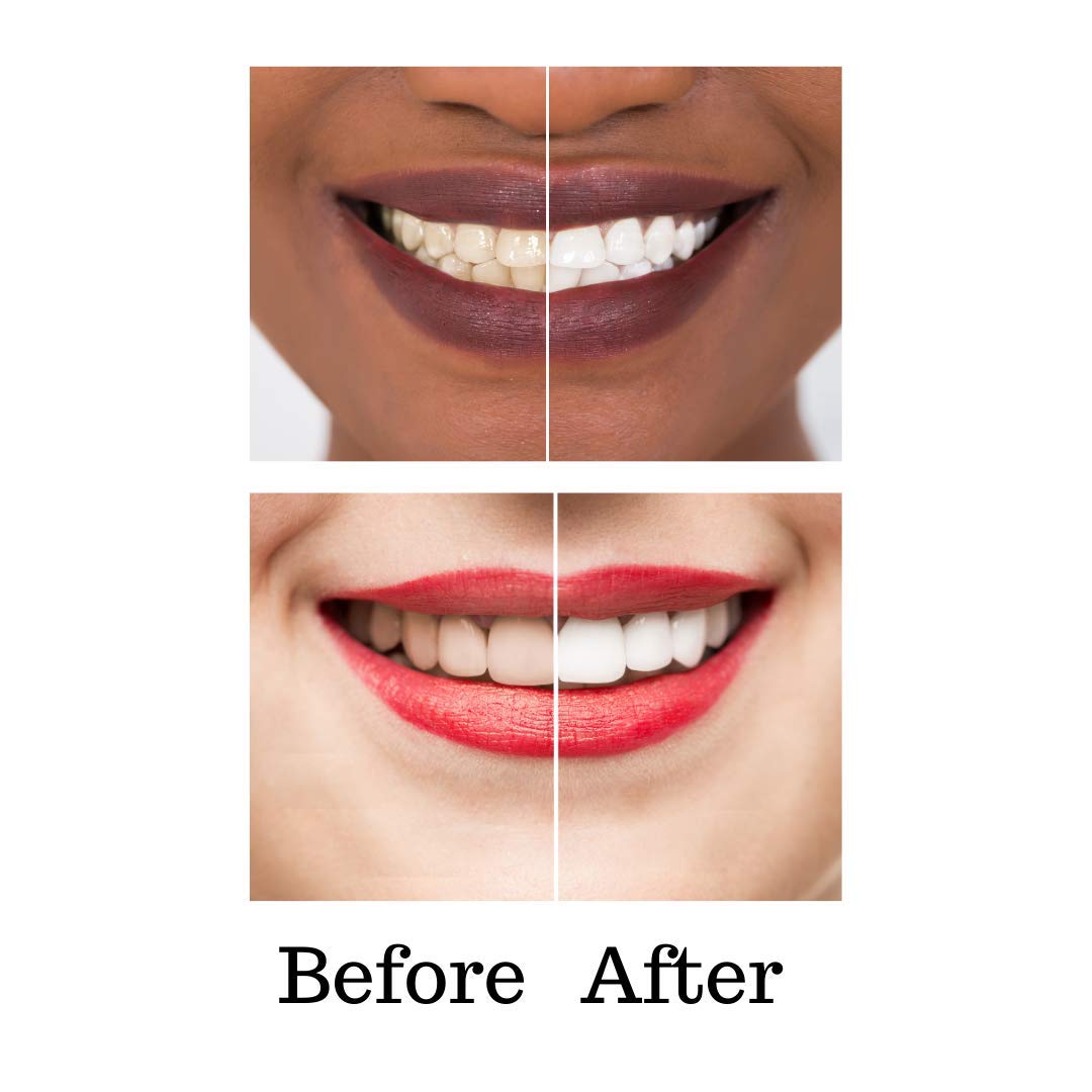Premium Teeth Whitening Kit with 2 x 4ml Carbamide Peroxide Pens (35% Whitening Gel) - Made in USA - Brighten Smile for Weddings, Photos & Special Occasions