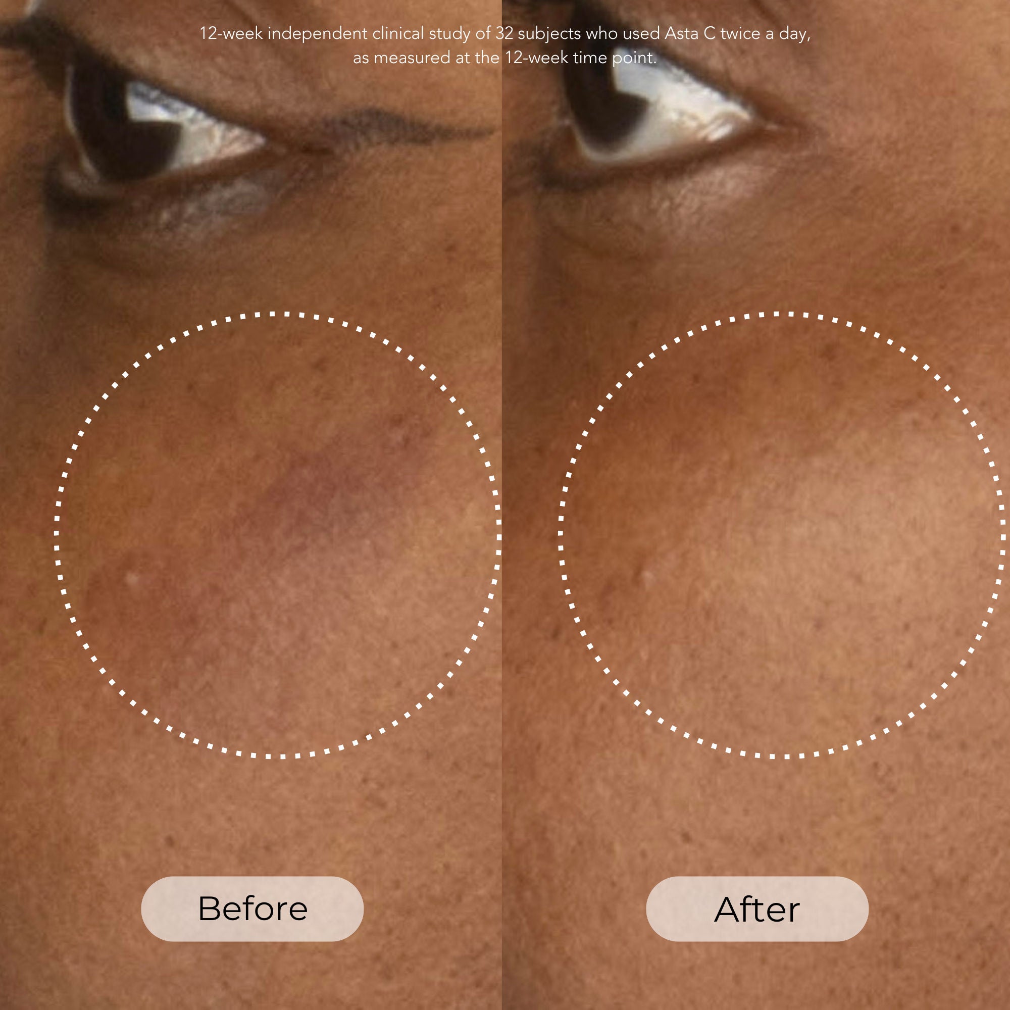 Asta C Vitamin C Age Defense Serum for Brightening & Anti-Aging - Best for Daily Skincare Routine & Dark Spot Reduction