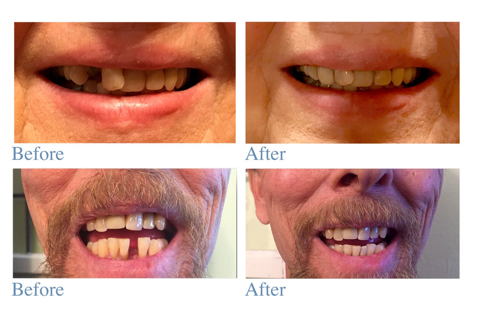 Instant Smile Deluxe Temporary Tooth Replacement Kit - 3 Natural Shades for Missing Teeth - Quick & Easy Solution for Gaps, Special Occasions & Everyday Confidence - Perfect for Photos, Weddings & Job Interviews