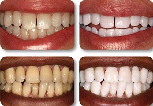 22% Teeth Whitening Gel - 5 Large Tubes (3.8ml Each) for Whiter Teeth & Brighter Smile | Professional Dental Care at Home for Special Occasions & Daily Confidence Boost