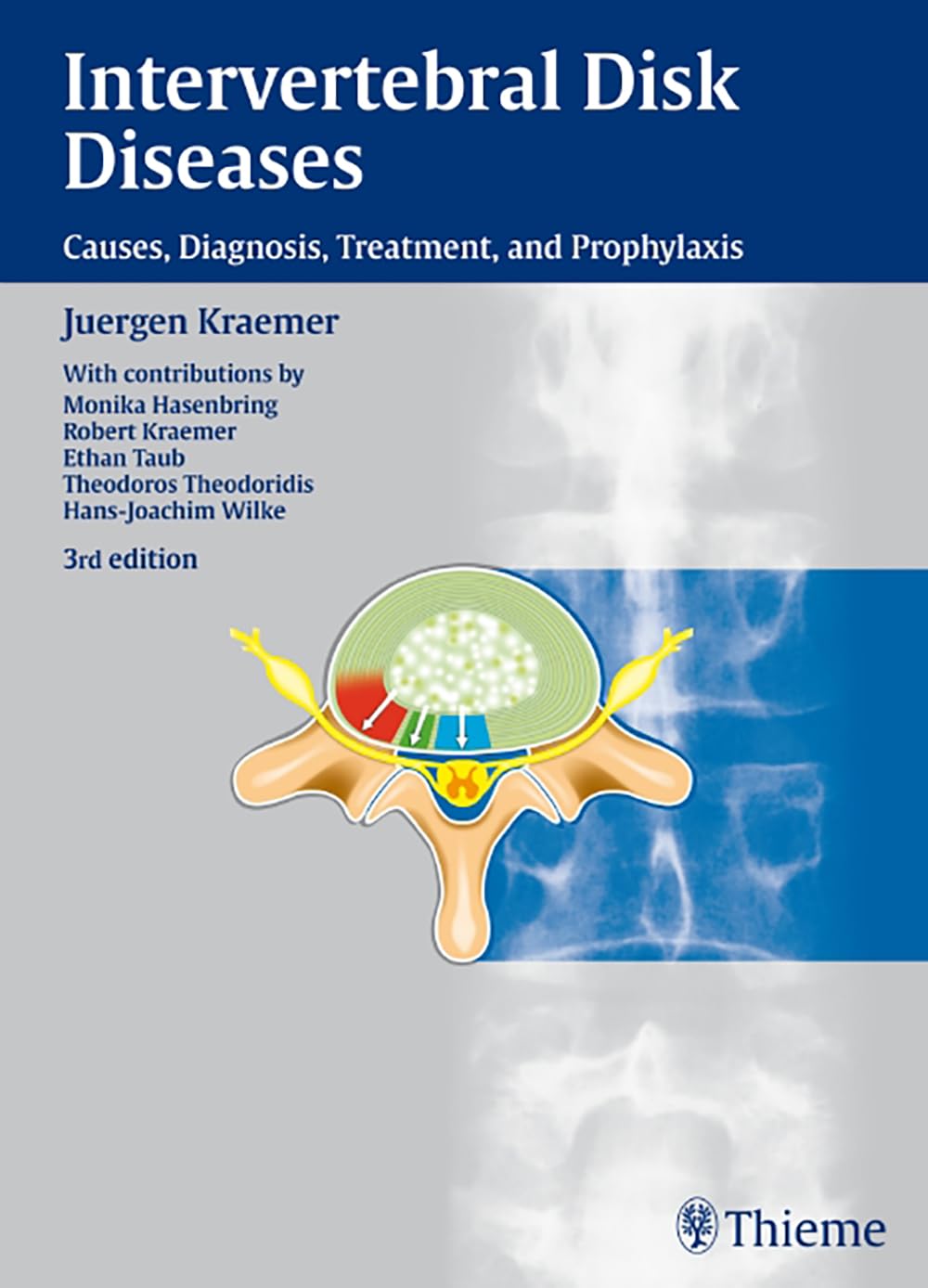 Intervertebral Disk Disease: Causes, Diagnosis, Treatment & Prevention - Relief for Back Pain & Spinal Health