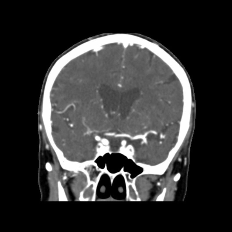 CTA Head Phantom for CT Scan & X-Ray Training - High-Quality Medical Imaging Education Tool for Radiology Students & Technicians