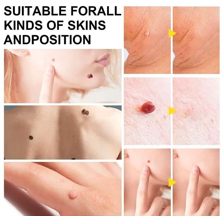 Best Skin Tag Remover Kit - 2 in 1 Auto Skin Tag Removal Device for Face & Body - Painless Wart & Mole Removal at Home - Perfect for Sensitive Skin Care Routine