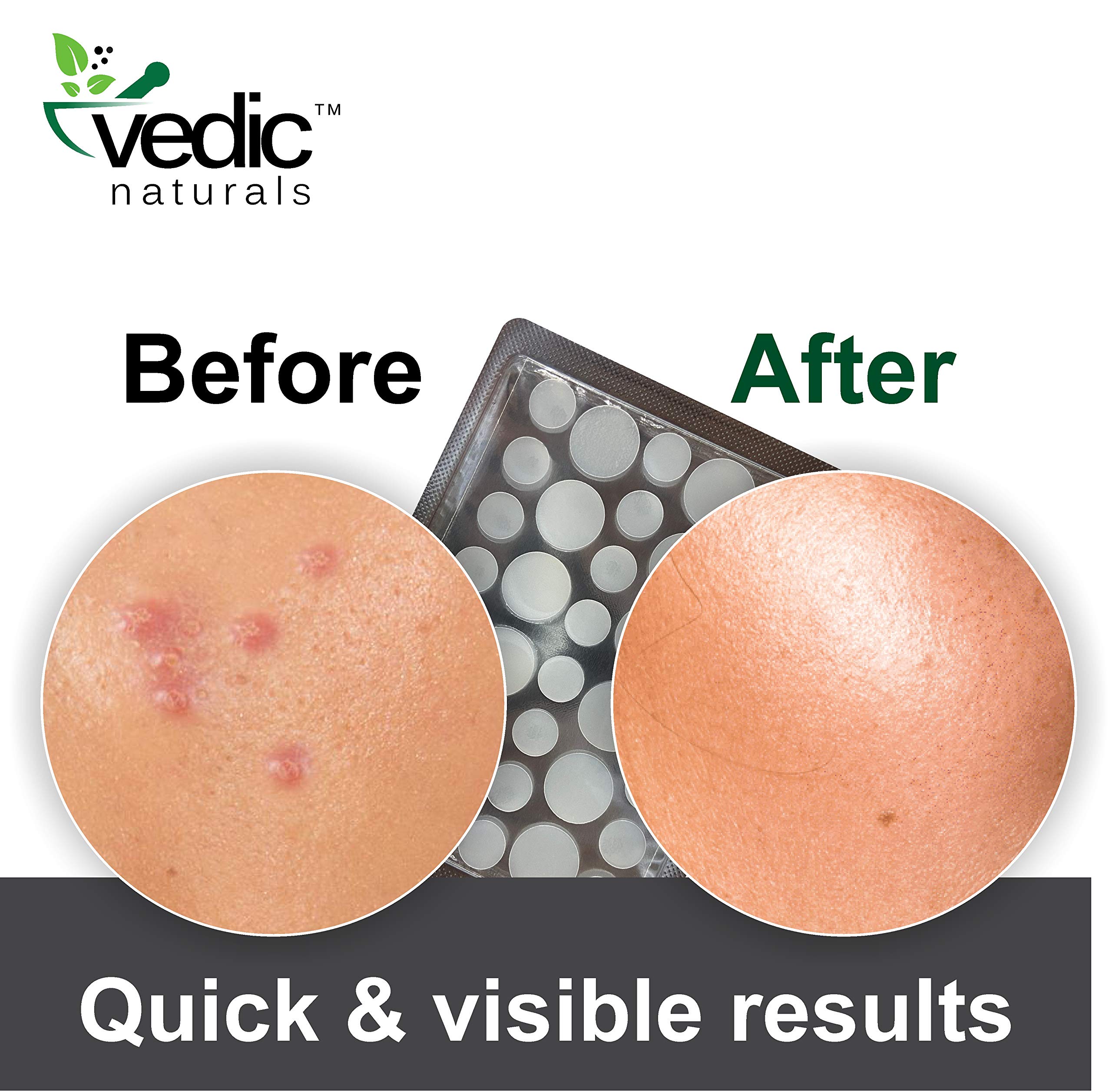 Vedic Naturals Hydrocolloid Acne Pimple Patches - 36 Count Transparent Face Stickers for Fast Pimple Healing | Skin Treatment Cover for Teens & Adults | Drug-Free, Non-Drying & Waterproof | Perfect for Overnight Spot Treatment & Daily Blemish Care