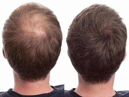 Premium Hair Building Fibers for Thick Hair - Instant Volume & Coverage - Dark Brown (25g) | Natural-Looking Hair Loss Solution for Men & Women | Perfect for Daily Use, Special Occasions & Confidence Boosting