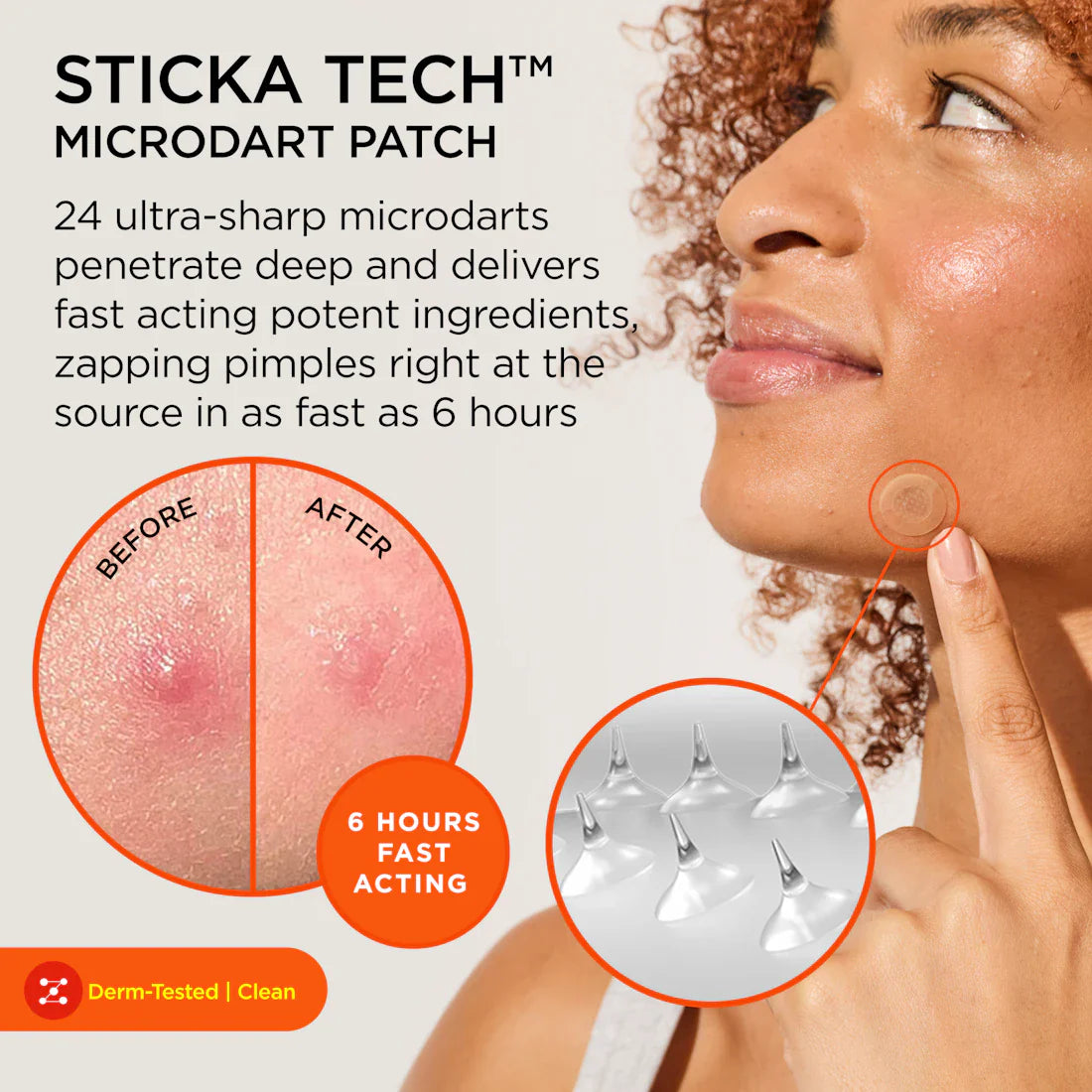 Killa Deep Zit Microdart Pimple Patch Kit - Acne Treatment Patches for Face & Body | ZitSticka | Perfect for Overnight Spot Treatment & On-the-Go Breakout Care