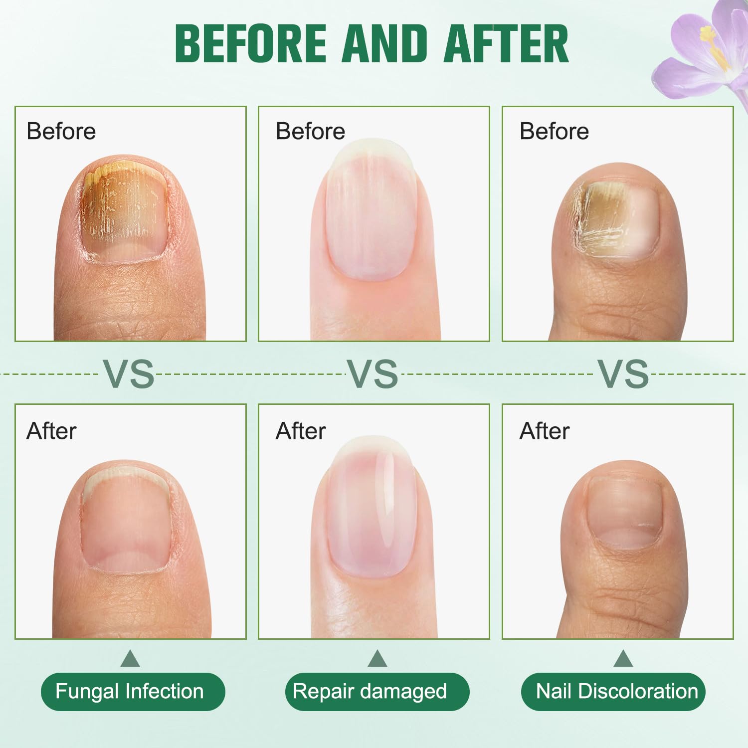 3PCS Plant Drops - Natural Oregano & Tea Tree Nail Care Oil (10ml/0.34 Fl.oz) for Repairing Damaged & Discolored Nails - Perfect for At-Home Manicures & Nail Restoration Treatments