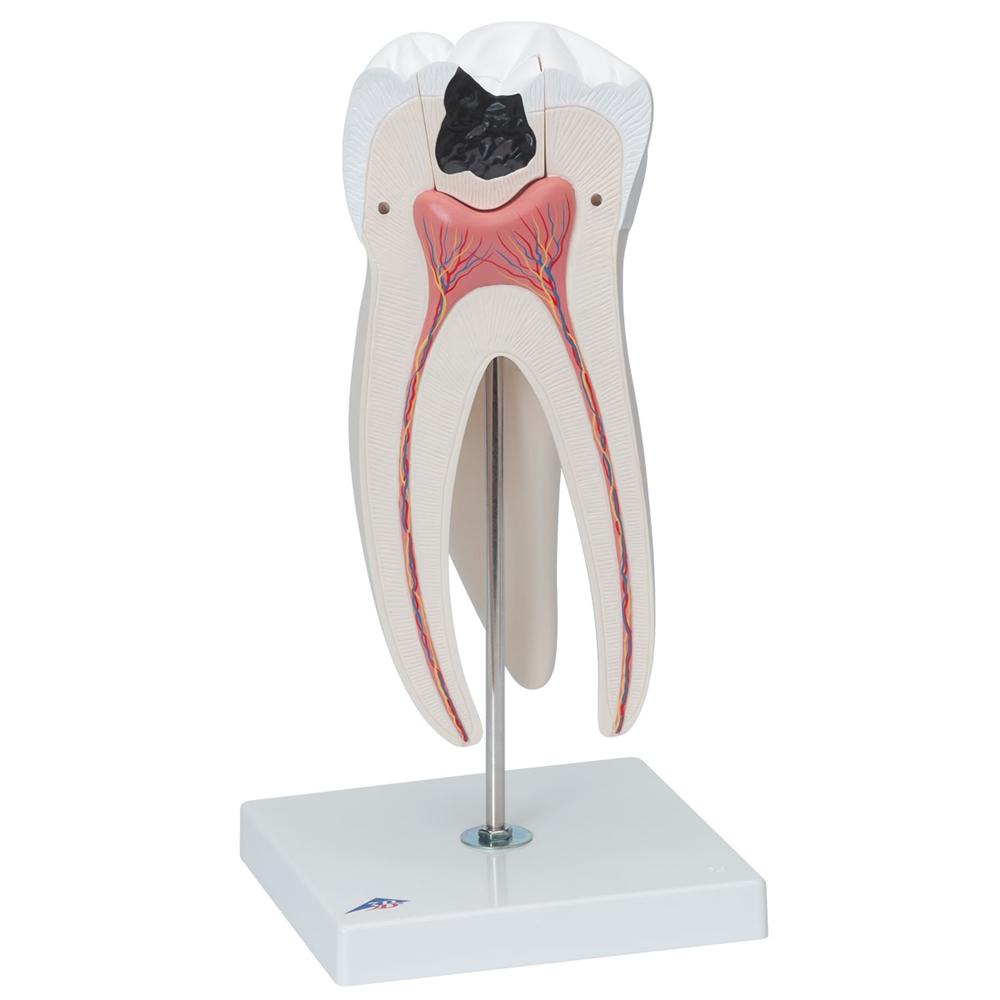 Giant Molar with Cavities - 15x Life Size Dental Model (5-Part) - Perfect for Dental Education, Classroom Demonstrations & Medical Training