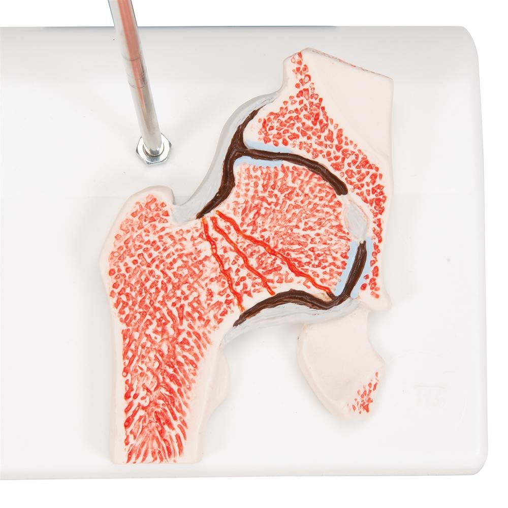 Femoral Fracture & Hip Osteoarthritis Anatomical Model - Medical Training, Student Education, and Clinical Demonstration Tool