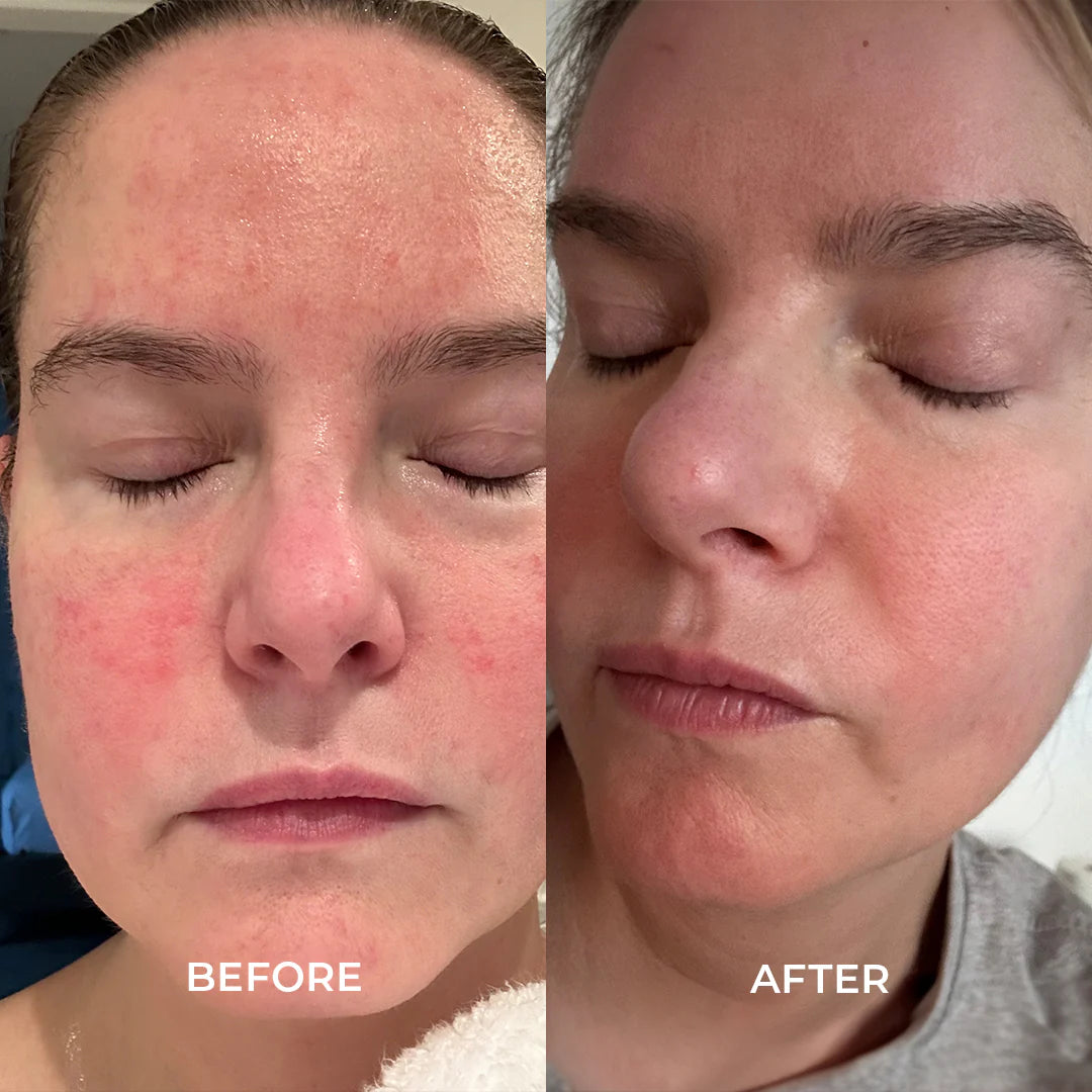 Face Rescue Cream - Hydrating & Soothing Moisturizer for Dry & Sensitive Skin | Perfect for Daily Skincare & Post-Treatment Care