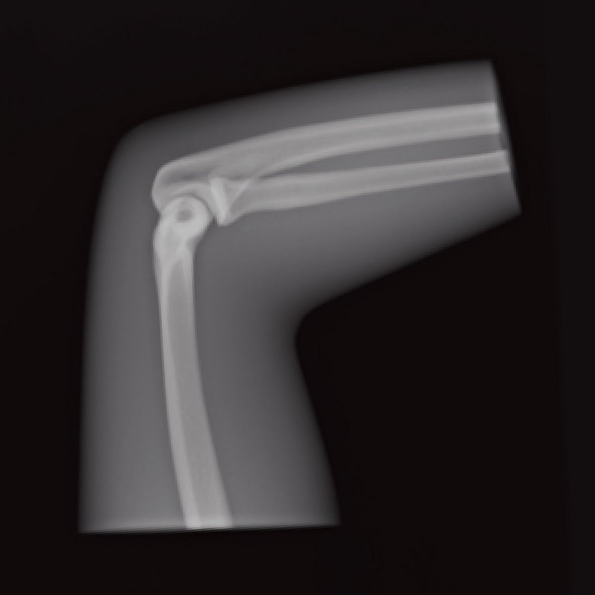 Elbow Phantom 90° Flexion Support Brace for Pain Relief & Joint Stability - Ideal for Tennis, Golf & Weightlifting