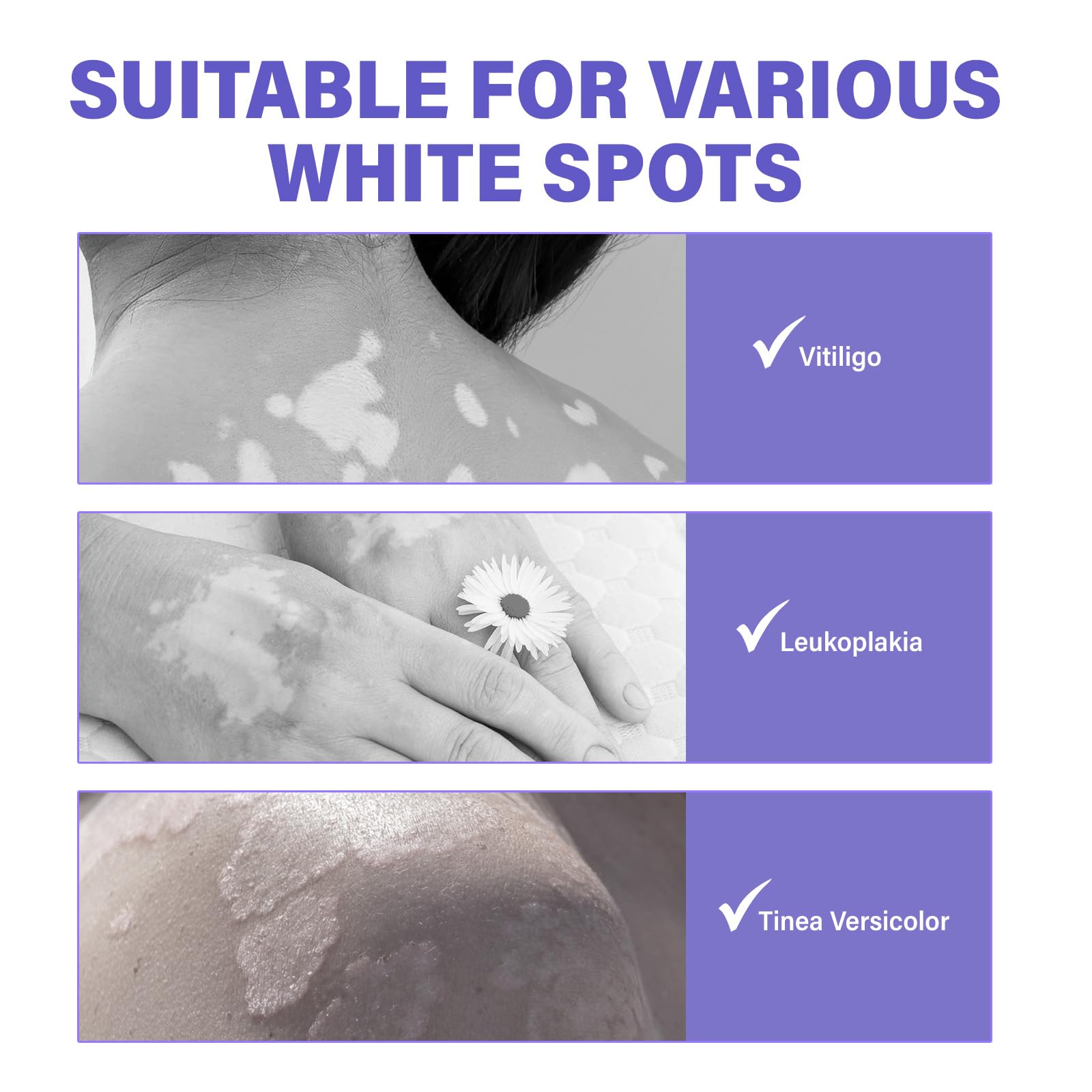 Natural Vitiligo Treatment Cream for Skin Pigmentation - Safe & Effective Solution to Restore Skin Tone | Perfect for Daily Use on Face & Body