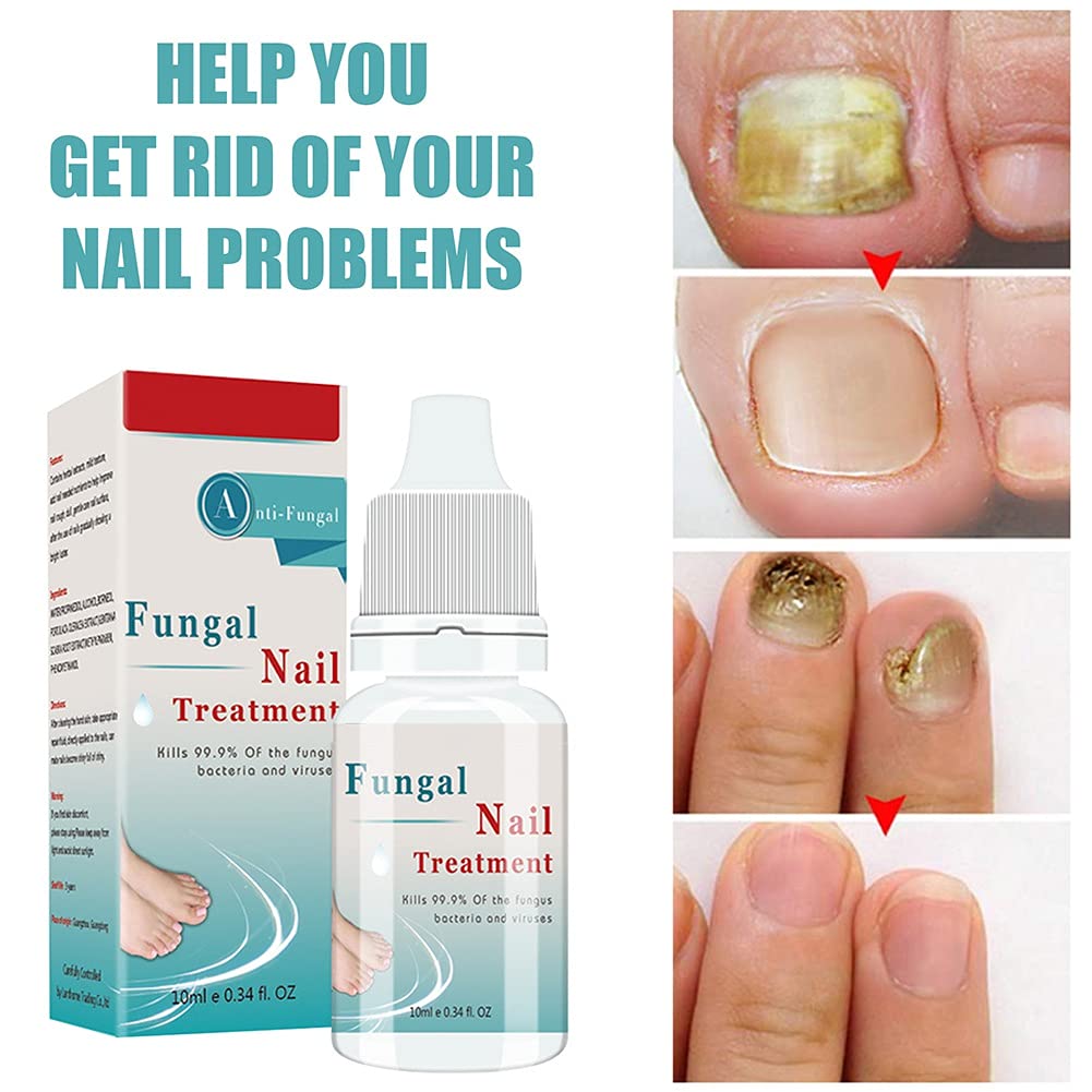 Extra Strong Nail Fungus Treatment - Repair Damaged Toenails for Men & Women - Perfect for Athletes & Daily Use