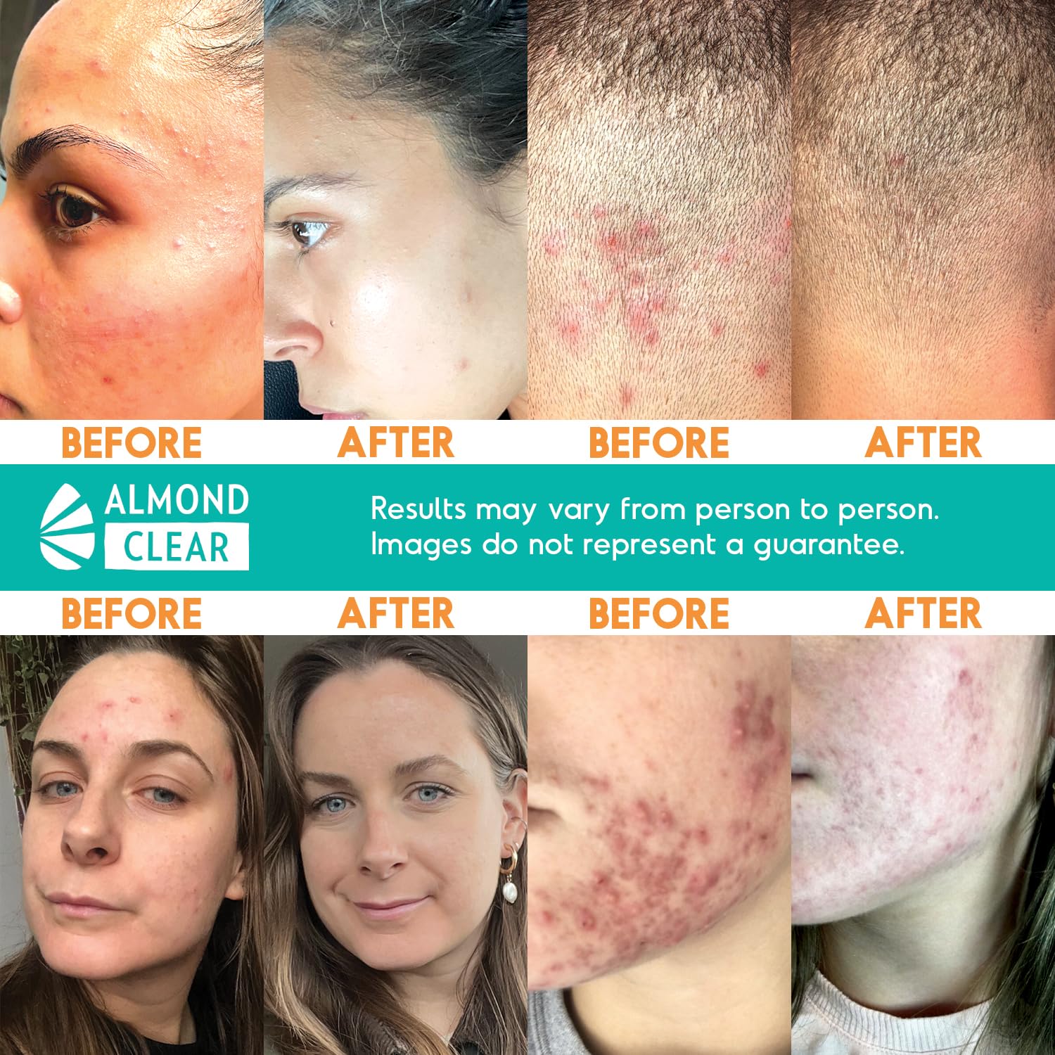 Best Skin Care Kit for Normal & Dry Skin - Anti Acne & Folliculitis Treatment with Face Wash, Body Wash, Acne Serum & Daily Moisturizer | Hydrating & Soothing Skincare Routine for Clear & Healthy Skin at Home