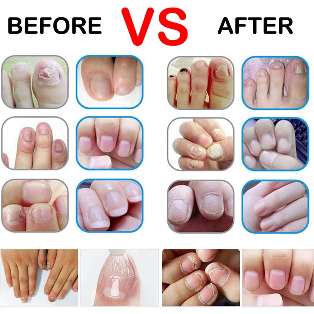 Allbestaye Fungal Nail Repair Pen - Effective Treatment for Onychomycosis & Paronychia, Restores Healthy Nails Damaged by Fungus | Anti-Fungal Nail Infection Solution for Toenails & Fingernails | Perfect for Daily Nail Care & Salon Use