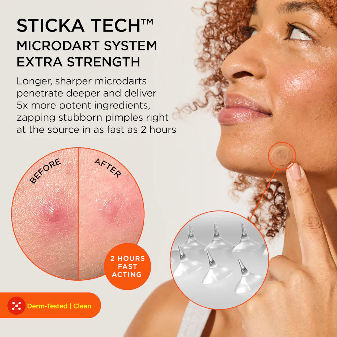 Killa Acne Extra Strength Microdart Patches - ZitSticka Acne Treatment for Face & Body - Fast-Acting Pimple Patches for Overnight Spot Treatment (60 Count) | Perfect for Travel, Gym & Daily Skincare Routine
