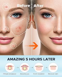 SSM Mart Hydrocolloid Acne Pimple Patches for Face - Spot Treatment Stickers for Blemishes & Breakouts | Calms & Relieves Acne Fast | Perfect for Overnight Use, Travel & Daily Skincare Routine