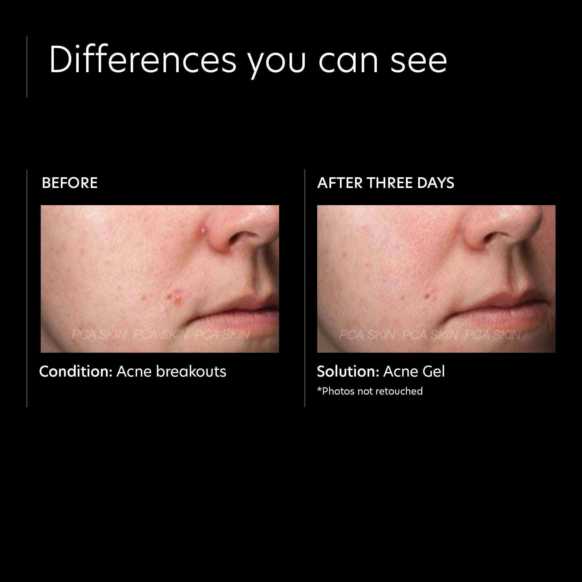 Best Acne Treatment Gel with OmniSome Technology - Fast-Acting & Gentle for Clear Skin | Perfect for Teen & Adult Acne Care