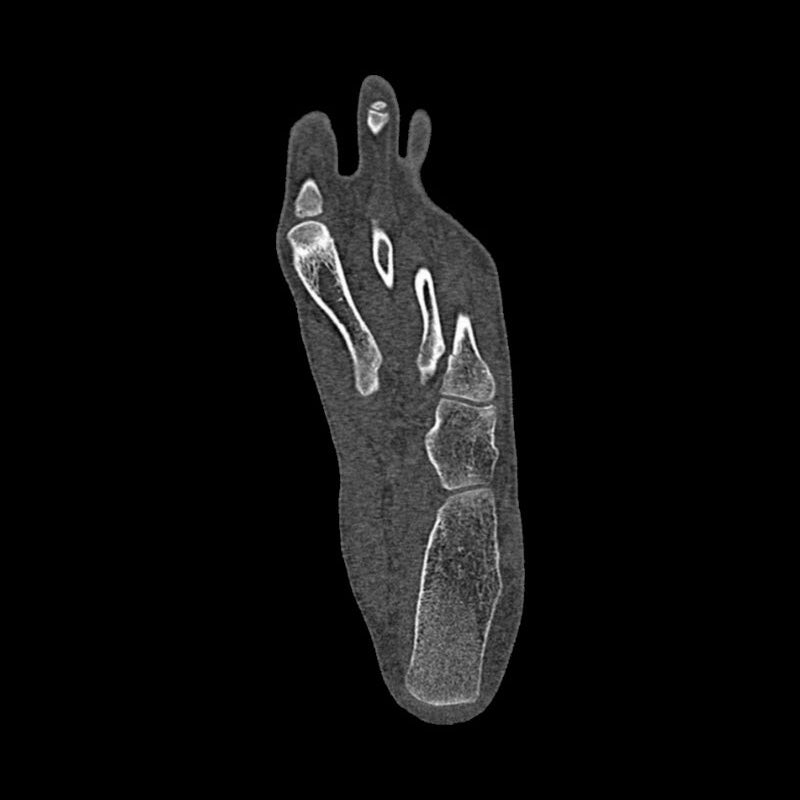 Foot Phantom Metatarsal Fractures Model - Realistic CT Scan & X-Ray Training Tool for Medical Students & Radiologists - Perfect for Anatomy Study & Diagnostic Practice