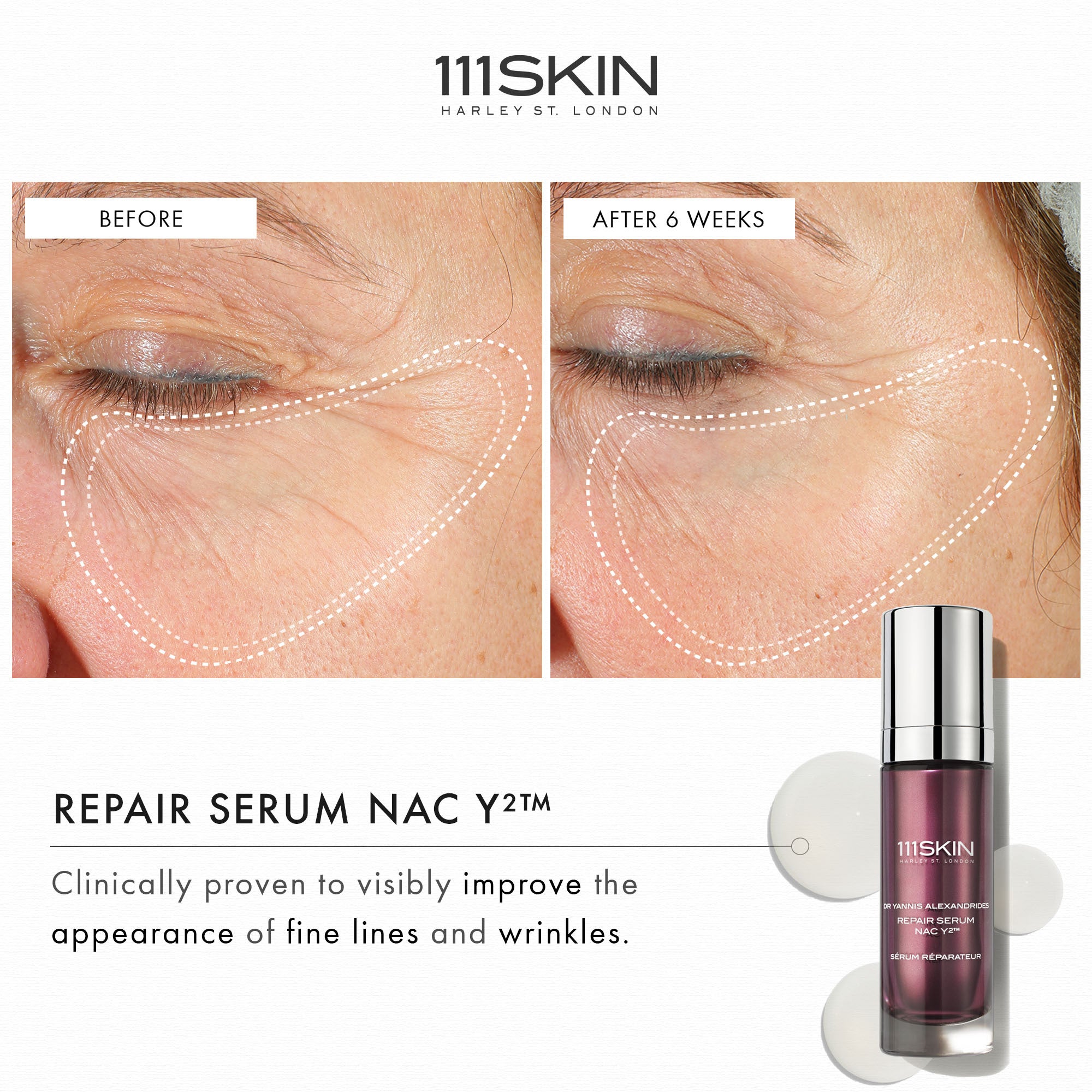 111Skin Repair Serum Nac Y2™ - Anti-Aging Face Treatment for Wrinkles & Fine Lines | Perfect for Nighttime Skincare Routine