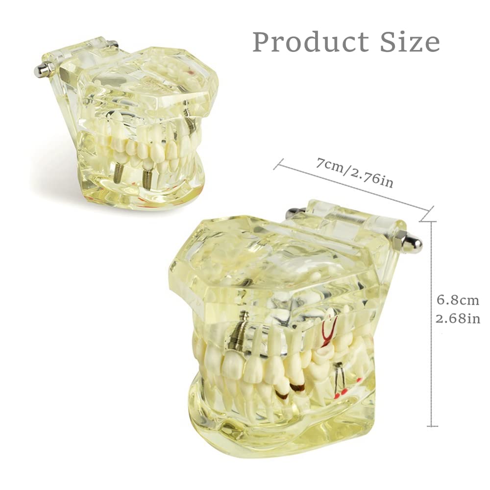 Dental Teeth Model - Transparent Implant Disease Removable Tooth Demonstration Kit for Dental Students & Professionals | Perfect for Classroom Teaching, Clinical Training & Patient Education