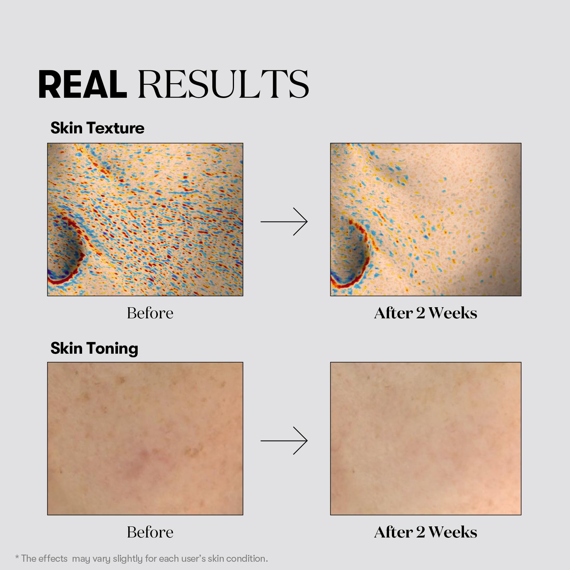 VT COSMETICS TX Toning Essence 1000 Shot - Brightening Serum with Tranexamic Acid, Niacinamide & Glutathione for Glass Skin | Dark Spot Corrector, Acne Scar Treatment | Fragrance-Free Korean Skincare for Sensitive Skin | Perfect for Daily Brightening Routine & Night Repair