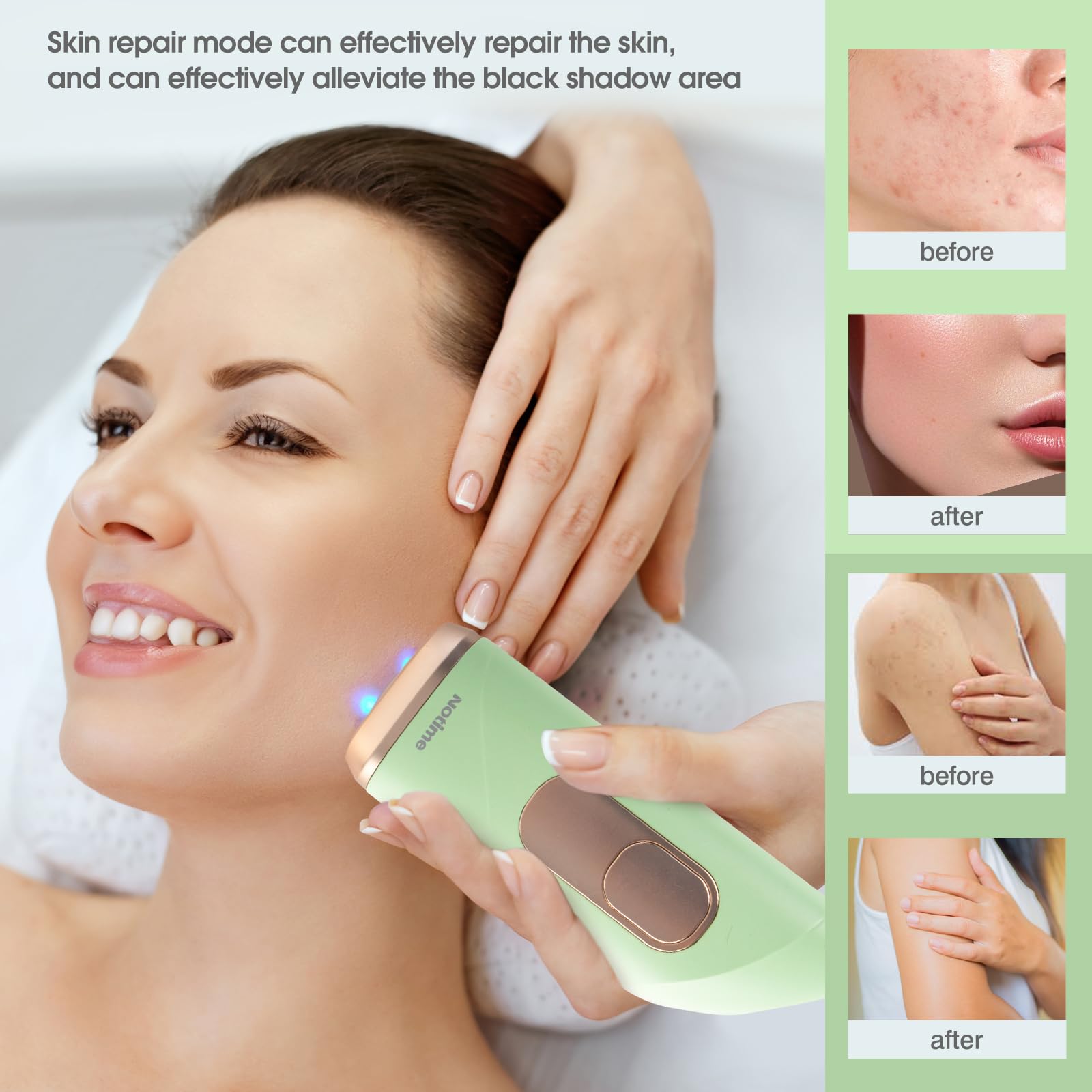 ICELADY Painless Permanent Hair Removal System for Women & Men - Full Body IPL Laser Hair Removal Device for Smooth Skin | At-Home Use for Legs, Face, Bikini Line & Underarms