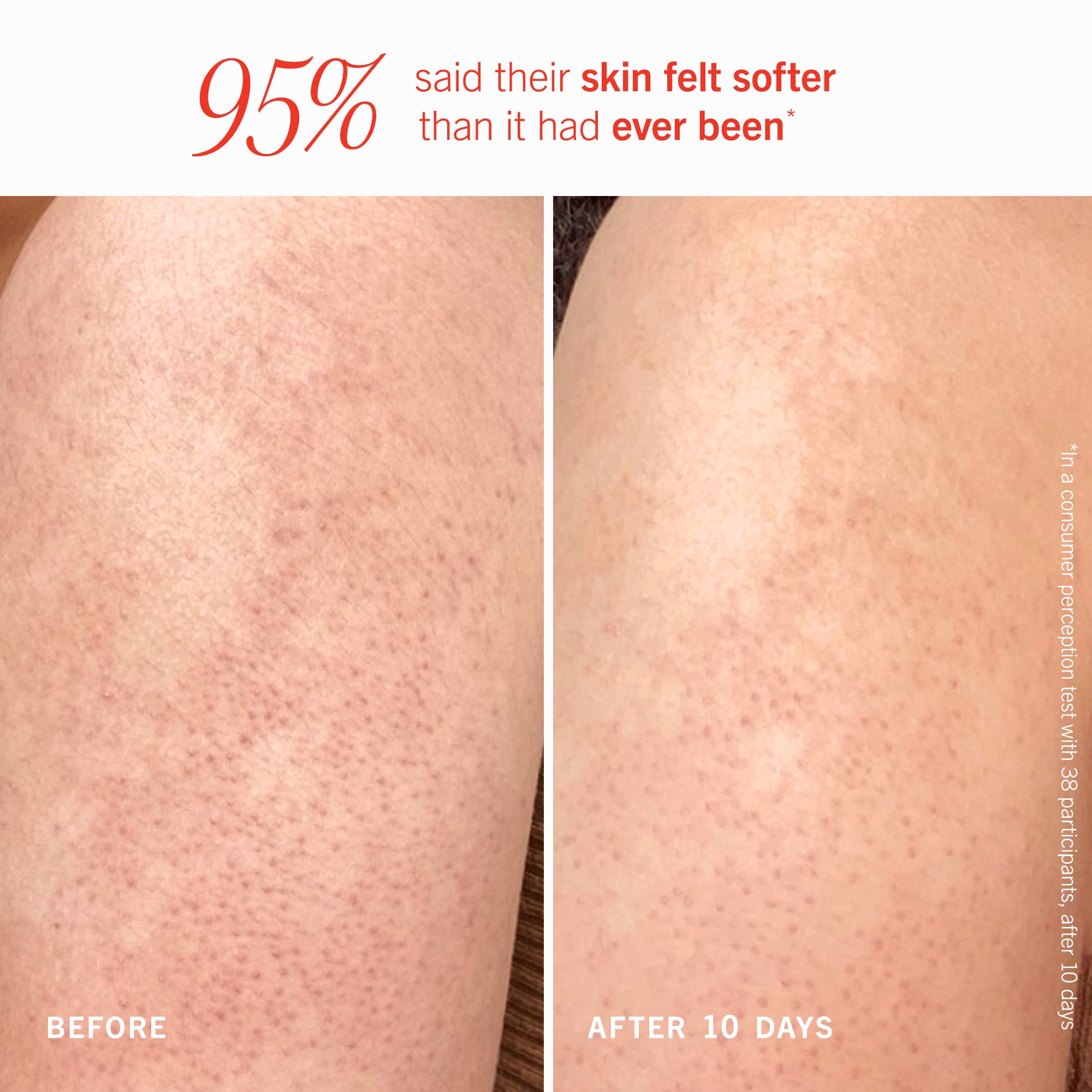 KP Bump Eraser Body Scrub with 10% AHA - Exfoliating Treatment for Keratosis Pilaris & Rough Skin - Fresh Peach Scent - Travel Size (3.4oz) - Perfect for Showers, Spa Days & On-the-Go Skincare
