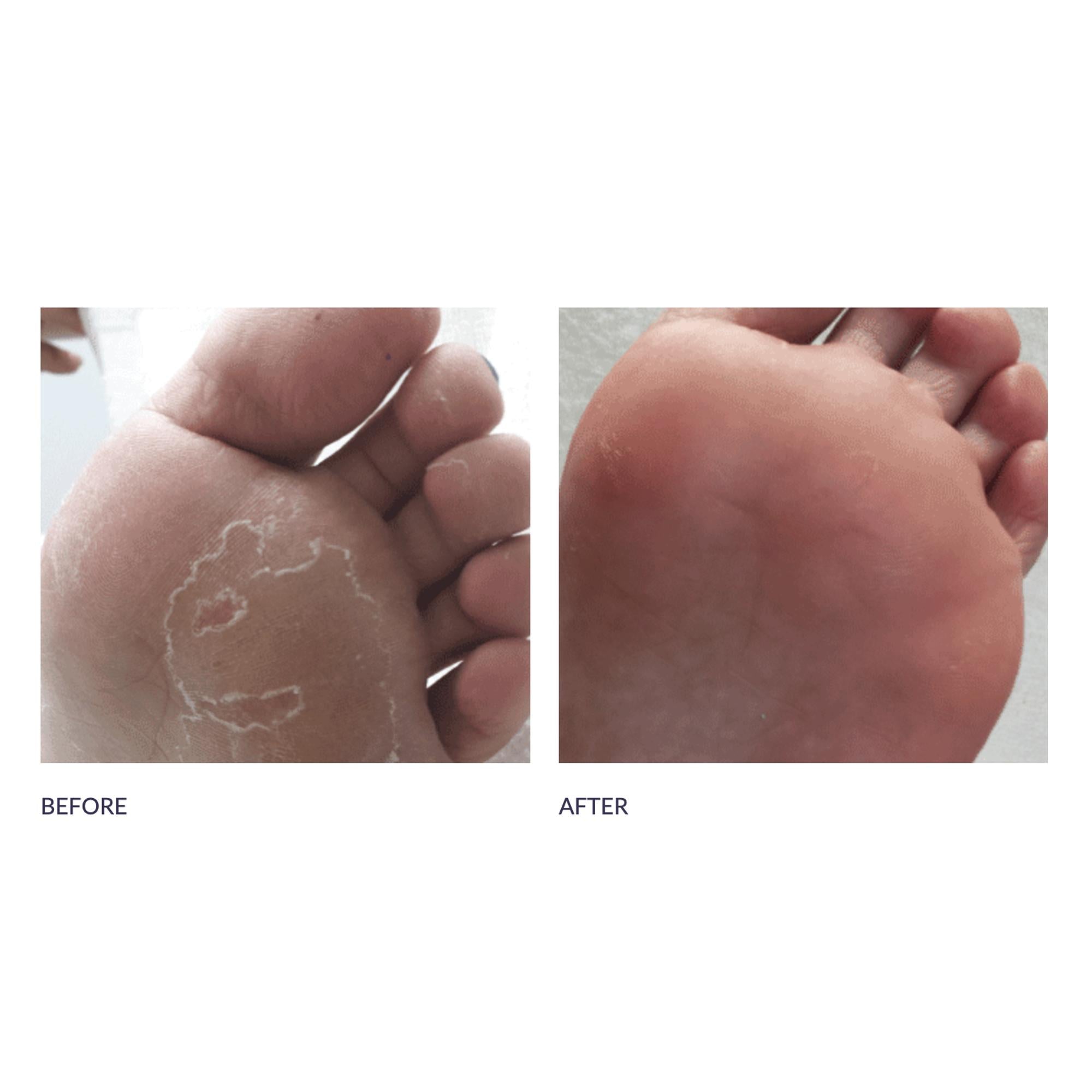 Footlogix Peeling Skin Formula for Dry & Cracked Feet - 4.2oz Moisturizing Foot Cream - Exfoliating Treatment for Calluses & Dead Skin - Perfect for Pedicures & At-Home Foot Care