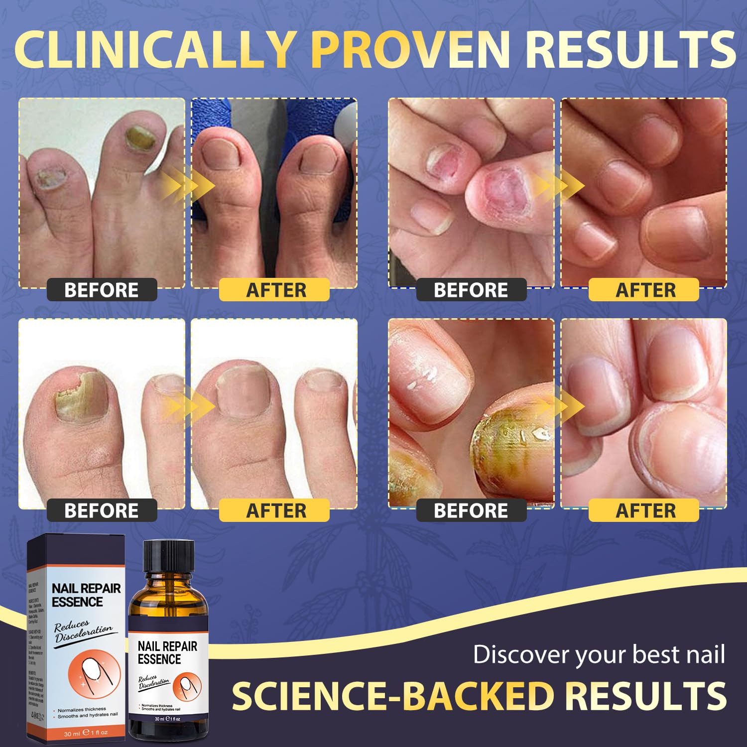 Extra Strength Toenail Fungus Treatment - Natural & Safe Repair for Damaged & Discolored Nails (30ml) | Effective Solution for Athlete's Foot & Nail Infections | Home Pedicure Care