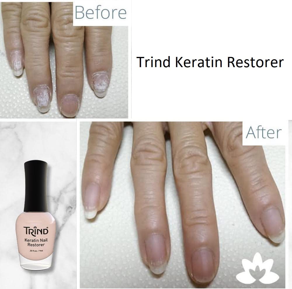 Trind Keratin Restorer - Nail Strengthener for Damaged & Brittle Nails, 9ml Treatment for Stronger, Healthier Nails | At-Home Nail Care Solution for Weak, Peeling Nails