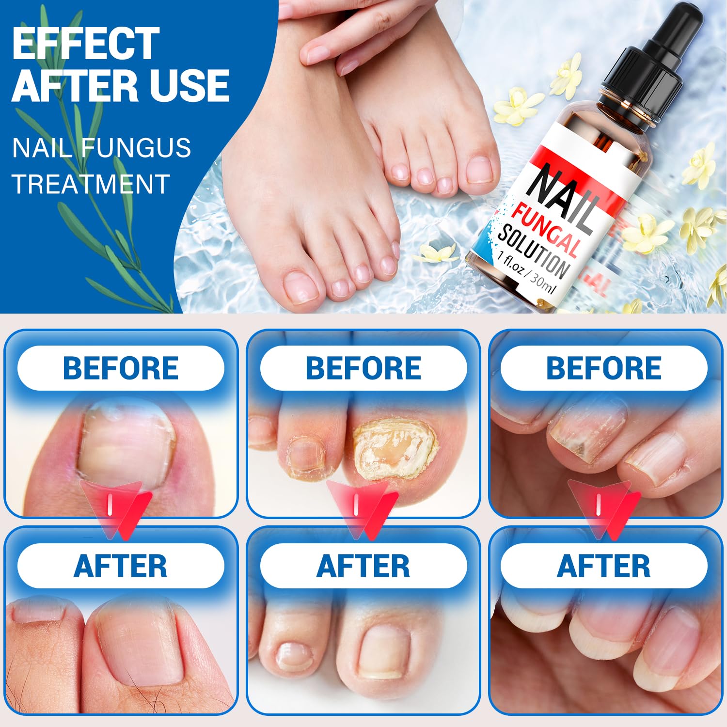 Extra Strength OMO Toenail Fungus Treatment for Toenails & Fingernails - 30ML Natural Nail Repair Liquid - Safe & Gentle Solution for Fungal Infections - Perfect for Athletes, Swimmers & Active Lifestyles