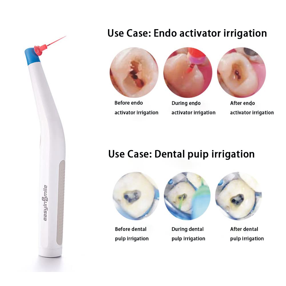 Sonic Endodontic Activator with 60 Soft Bendable Polymer Tips - Durable Dental Tool for Root Canal Treatment & Endodontic Procedures - Perfect for Dentists & Endodontists