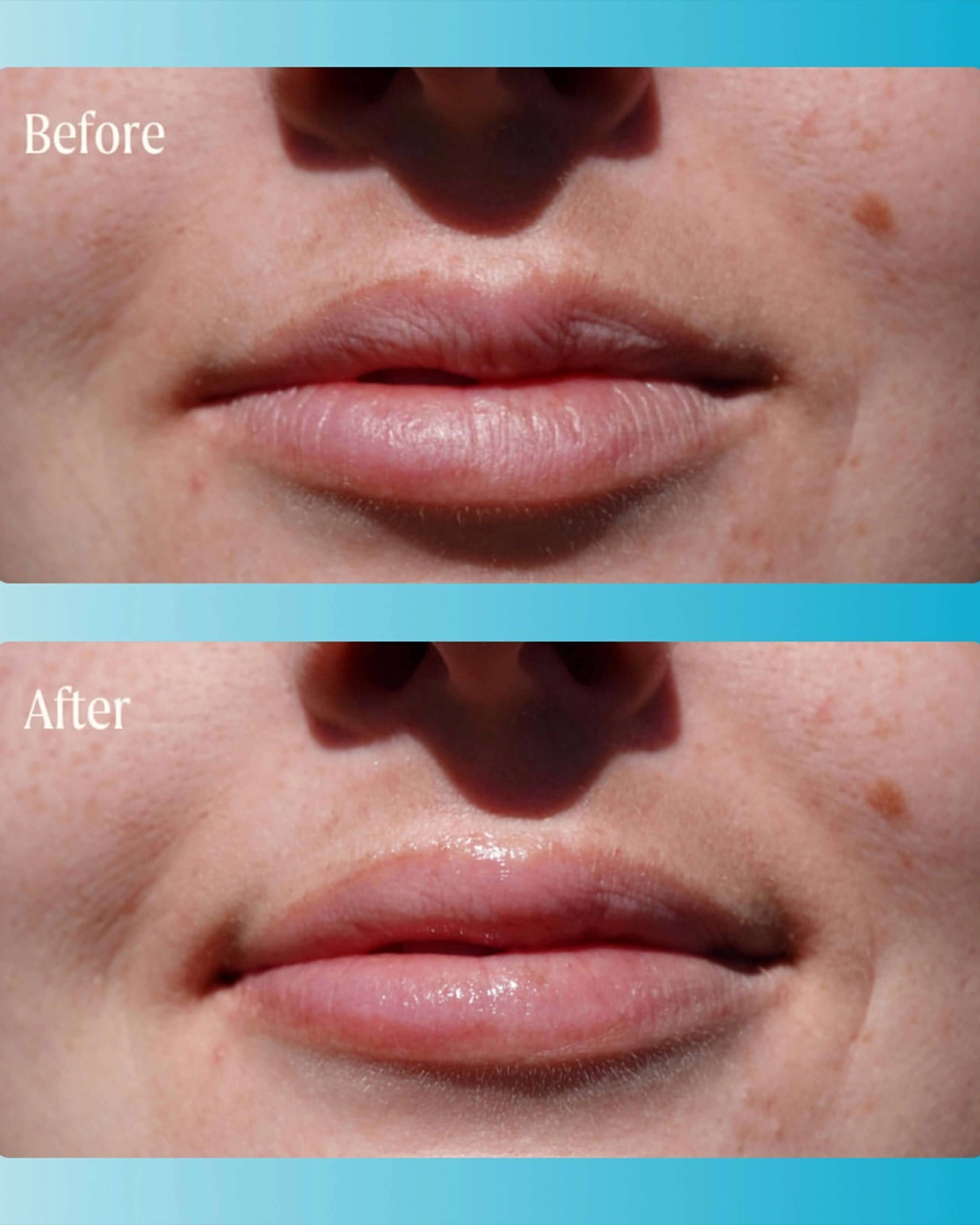 SuperMelt Hyaluronic Acid Lip Plumper - Hydrating & Volumizing Lip Treatment for Dry, Chapped Lips | Perfect for Daily Use, Night Care & Makeup Prep